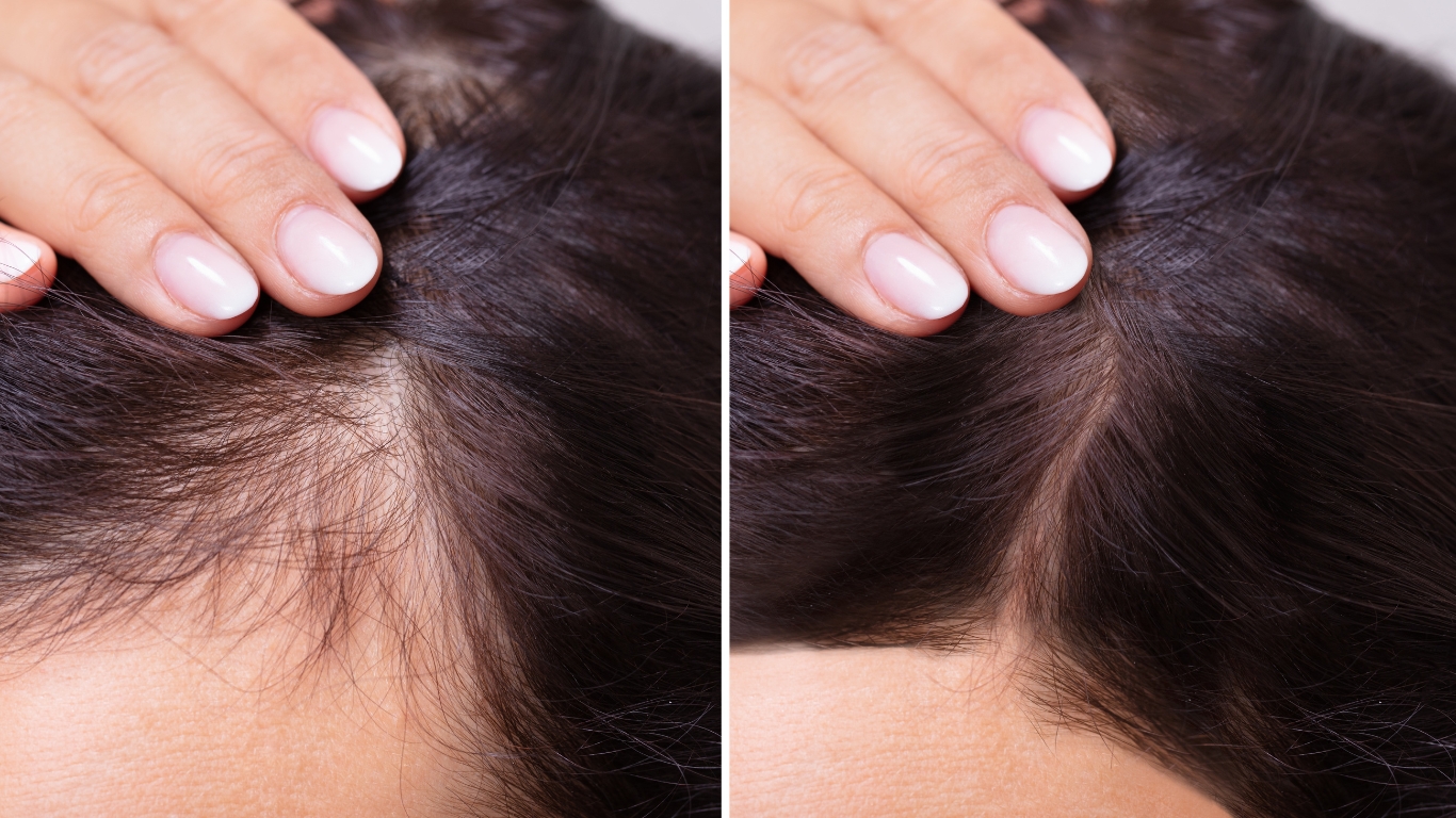 denver hair loss treatments
